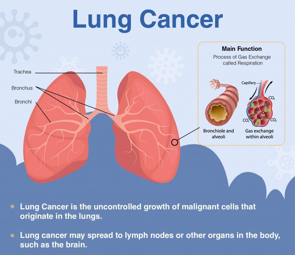 Symptoms that Point Towards Lung Cancer Treatment